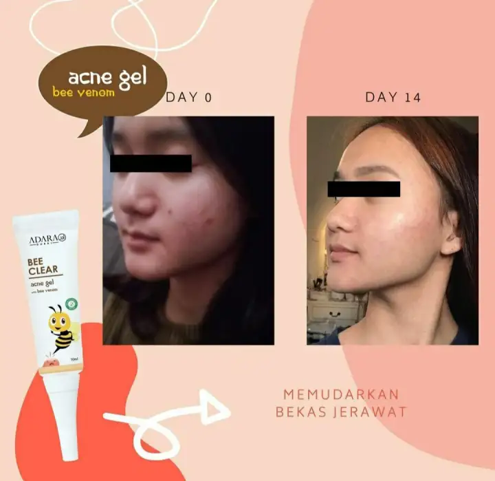 bee acne gel