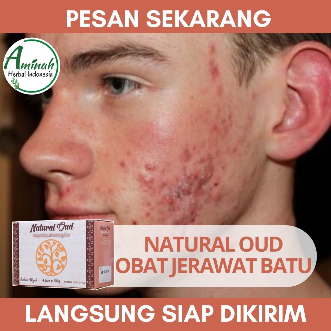 Obat Herbal Jerawat Batu Obat Khusus Jerawat Batu Obat Jerawat Batu Di Jidat Obat Jerawat Batu Di Pipi Obat Jerawat Batu Di Dagu Obat Jerawat Batu Hitam Obat Jerawat Batu Bernanah