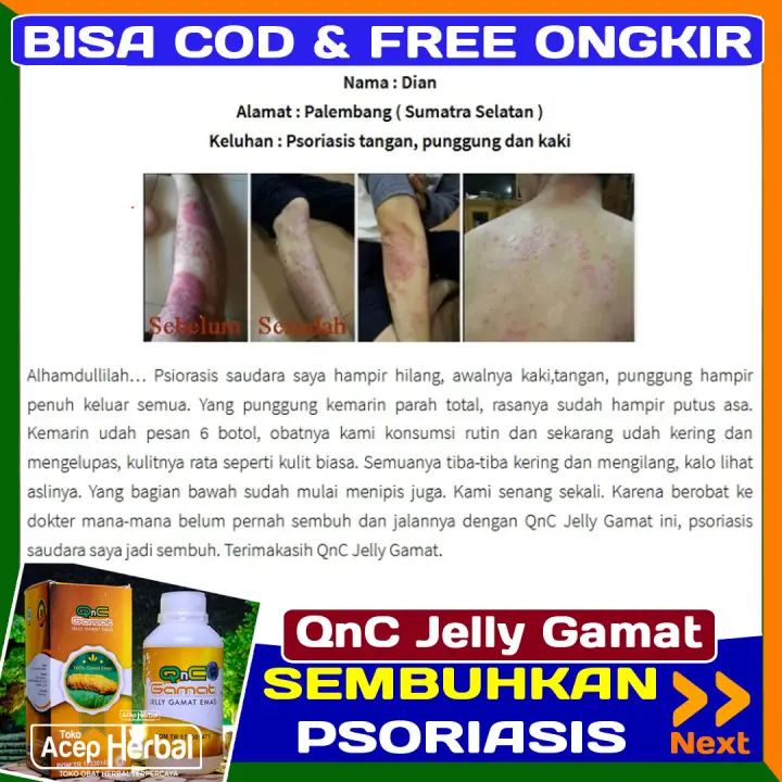 Qnc Jelly Gamat Solusi Penyembuhan Penyakit Psoriasis Obat Psoriasis Vulgaris Psoriasis Kulit Kepala Ditangan Kaki Punggung Dan Seluruh Tubuh Psoriasis Plak Kulit Kering Tebal Bersisik Dan Gatal Gutata Lazada Indonesia