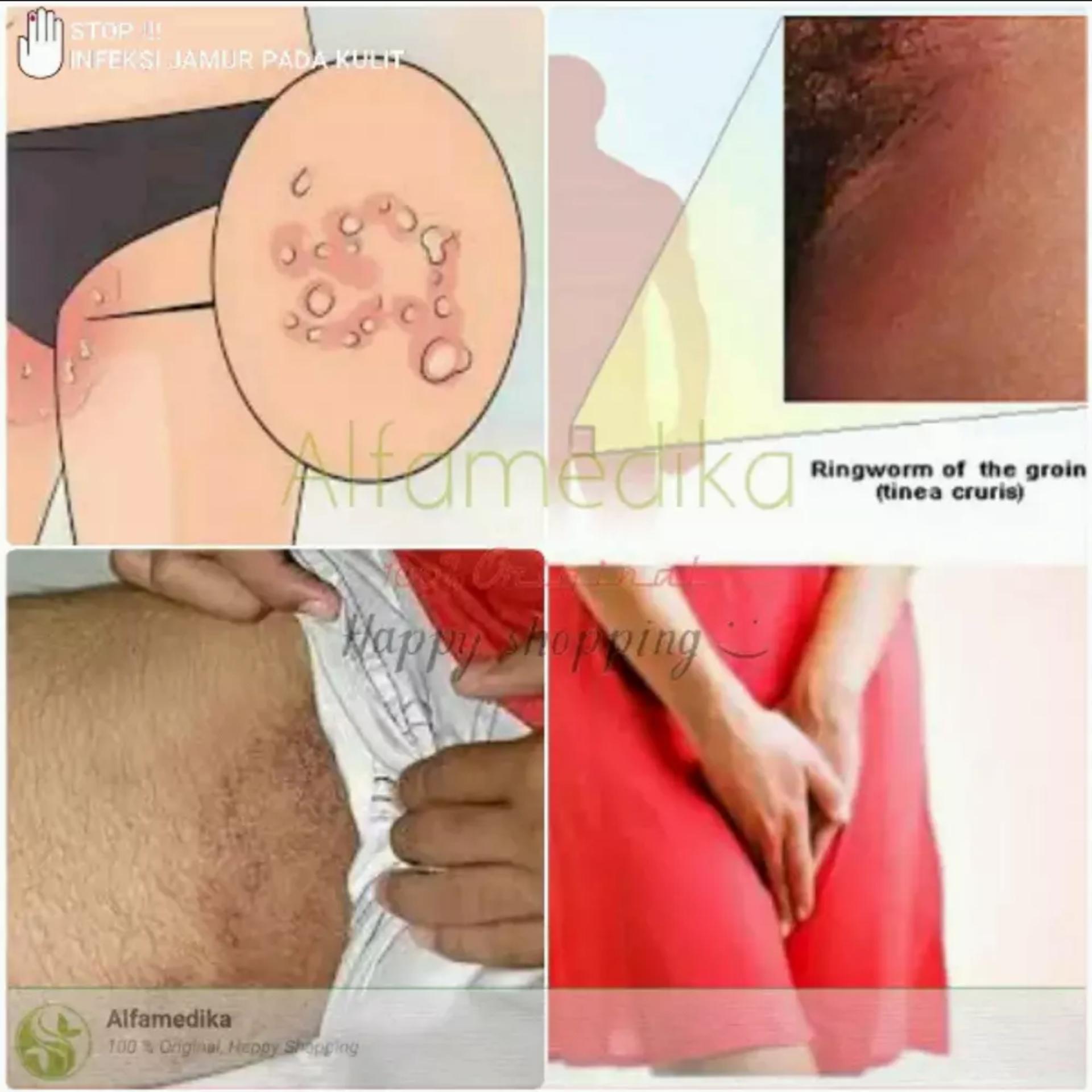 Salep Kulit Obat Cina Anti Jamur Panu Kadas Kudis Kurap Kutuair Herpes Eksim Kering Basah Gatal-Gatal Alergi Gatal Selangkangan Selakangan Slakangan