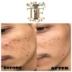 TLF Beauty Water Obat Jerawat Pria Manjur