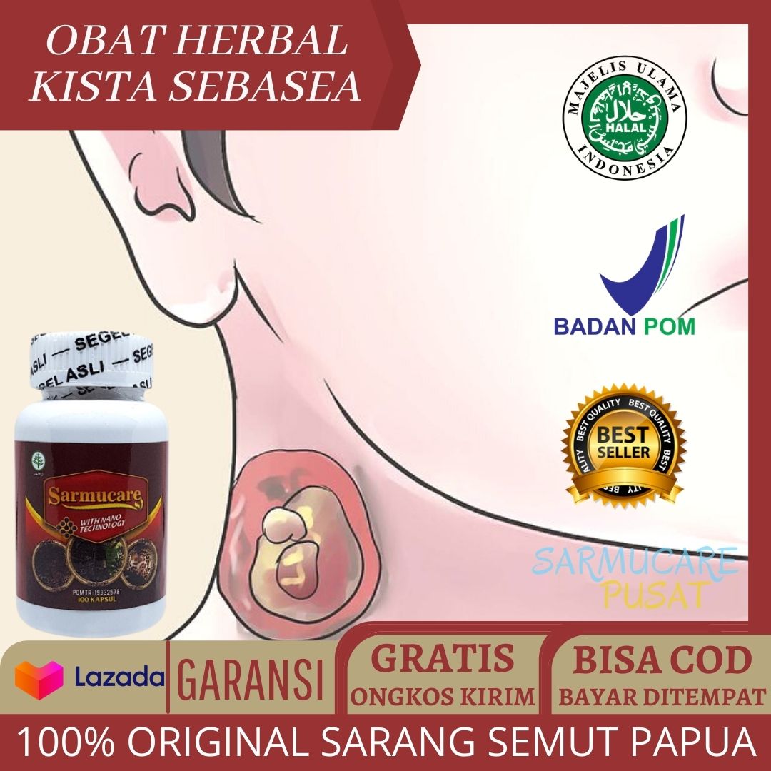 Obat Herbal Kista Sebasea, Kista Dermoid, Kista Epidermoid, Kista
