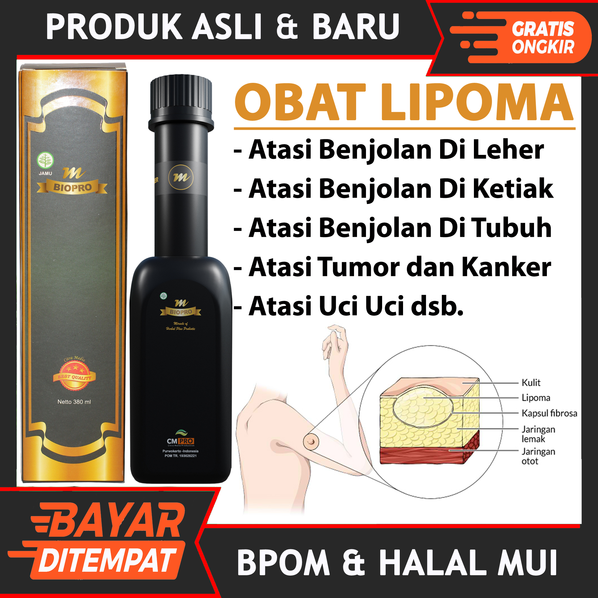 Obat Lipoma Benjolan Di Ketiak, Benjolan Dileher, Benjolan Dipayudara ...