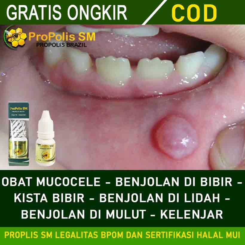 Obat Penghilang Mucocele Obat Mukokel Obat Benjolan Di Bibir Obat Kista Bibir Obat Pengempis Dan Penghilang Benjolan Kista Di Lidah Obat Benjolan Di Mulut Obat Kelenjar