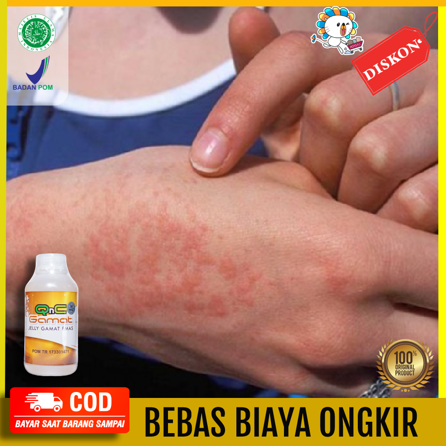 Obat Alergi Matahari - Obat Penyakit Kulit - Obat Ruam Kulit - Kulit ...