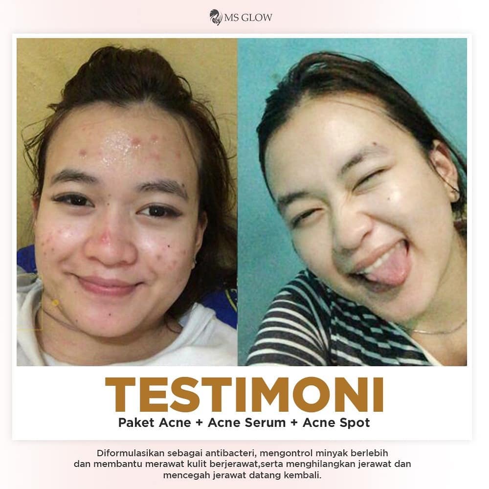 Ms Glow Acne Spot Treatment Ori Obat Totol Jerawat Lazada Indonesia