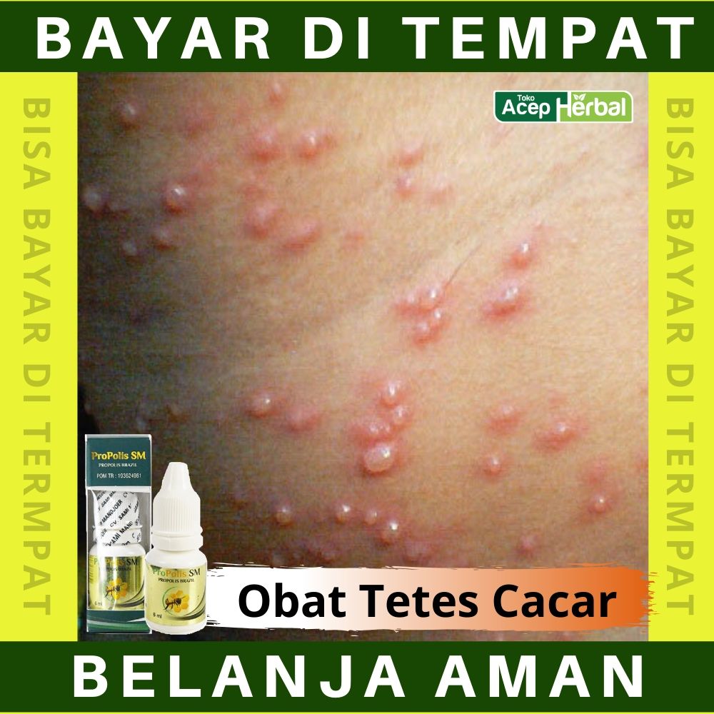 Obat Cacar Herbal Cairan Luka Cacar Air Api Untuk Kulit Anak Bayi Cacar Ular Perih Varicella Infeksi Virus Cocok Buat Semua Jenis Kulit Nyeri Tenggorokan Badan Lemas Pusing Demam Ibu Menyusui