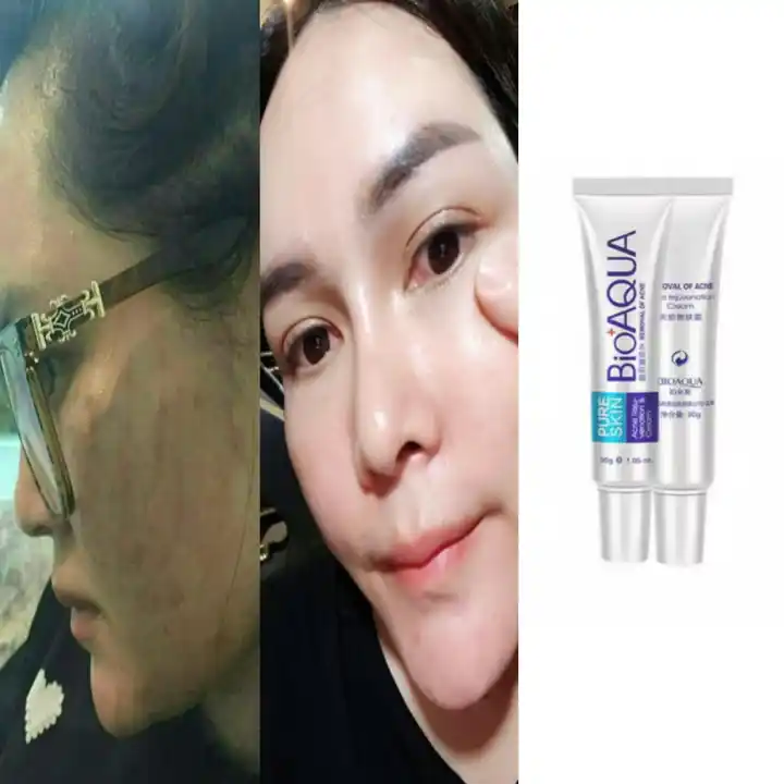 bioaqua acne rejuvenation cream bpom