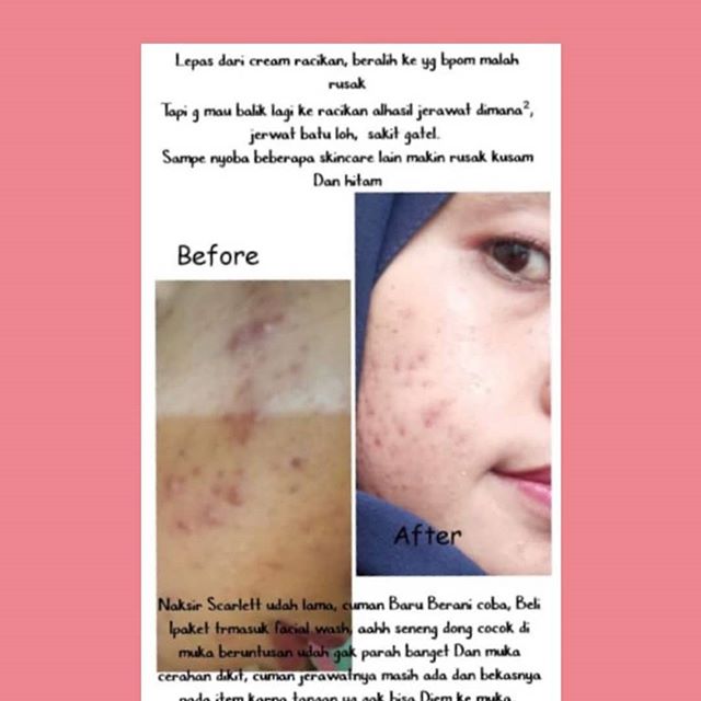 testi serum acne scarlett