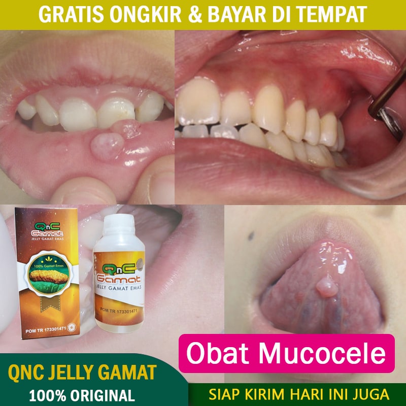 Obat Mucocele Mukokel Benjolan Di Bibir Kista Di Bibir Bejolan Di Bawah Lidah Benjolan Di Rahang Daging Tumbuh Di Bibir Obat Untuk Benjolan Bengkak Di Gusi Salep Oles Mucolele Dengan