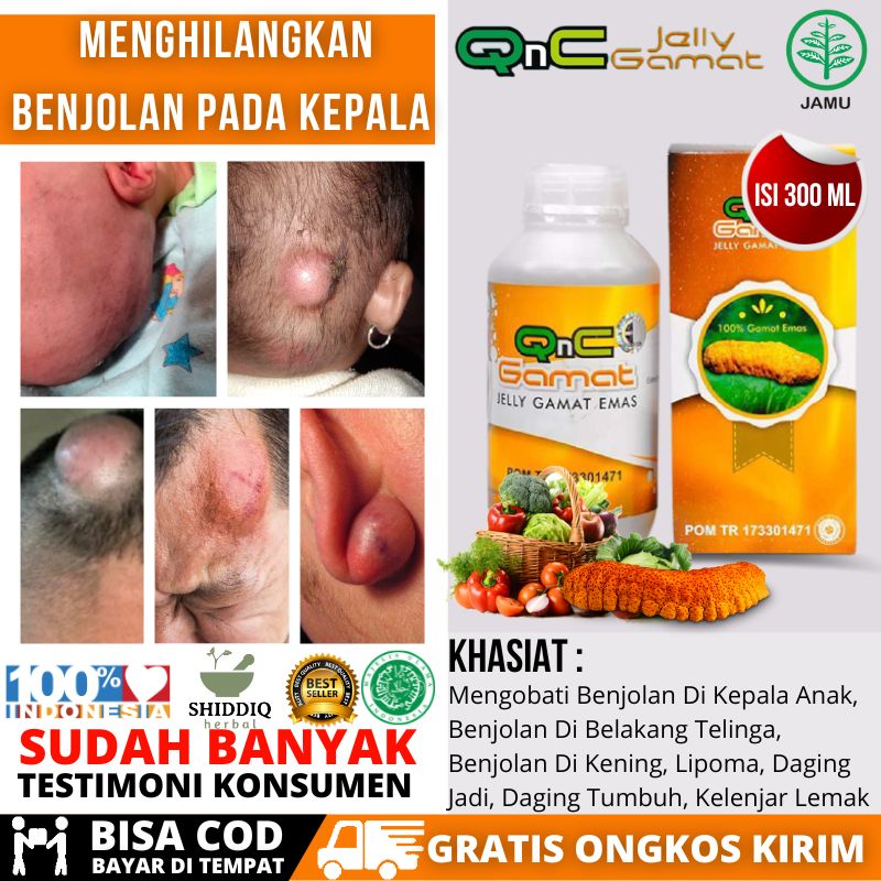 Obat Benjolan Di Kepala Bayi, Benjolan Di Kepala Anak Mengeras Bagian ...