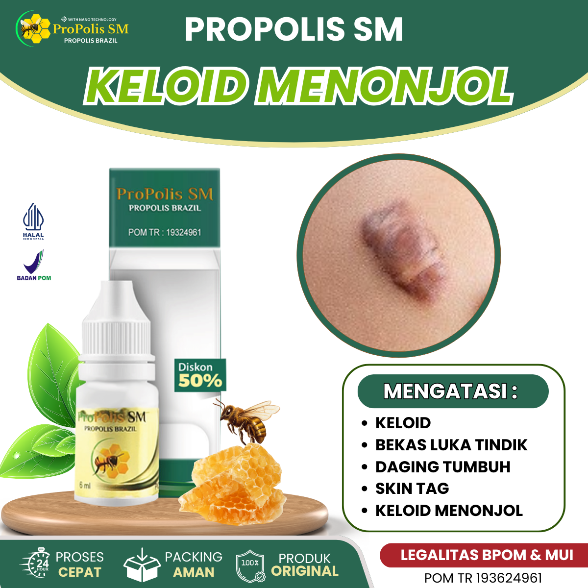 Obat Keloid Menonjol, Obat Bekas Luka Menonjol, Obat Keloid Daging