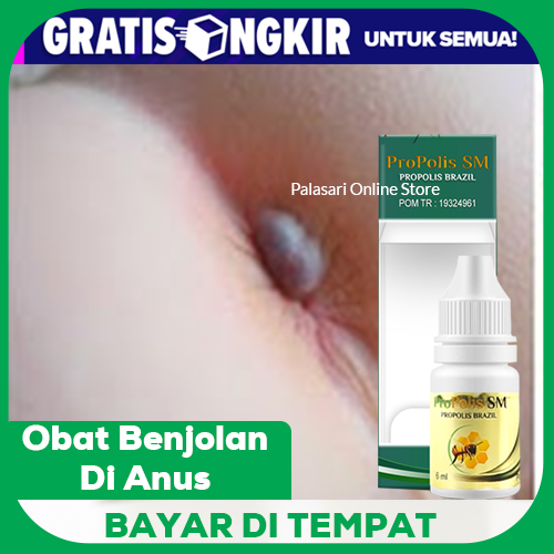 Obat Benjolan Di Anus Benjolan Di Dubur Tapi Bukan Wasir Bisul Di Anus Bisul Di Dubur Hematoma Benjolan Anus Lazada Indonesia