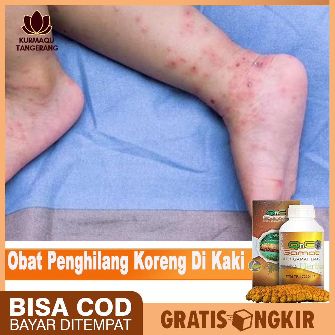 Cara menghilangkan bekas koreng di kaki yang sudah bertahun tahun