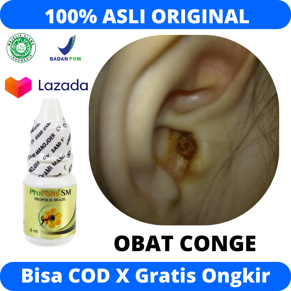 Congek Obat Congek Menahun, Congek Telinga Anak Bayi Dan Dewasa, Kuping Berair ...