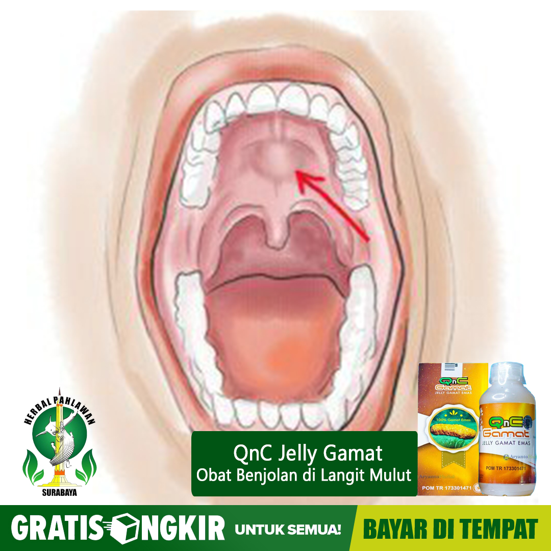 Obat Benjolan di Langit Mulut - QNC Jelly Gamat di Kota Surabaya | Lazada  Indonesia