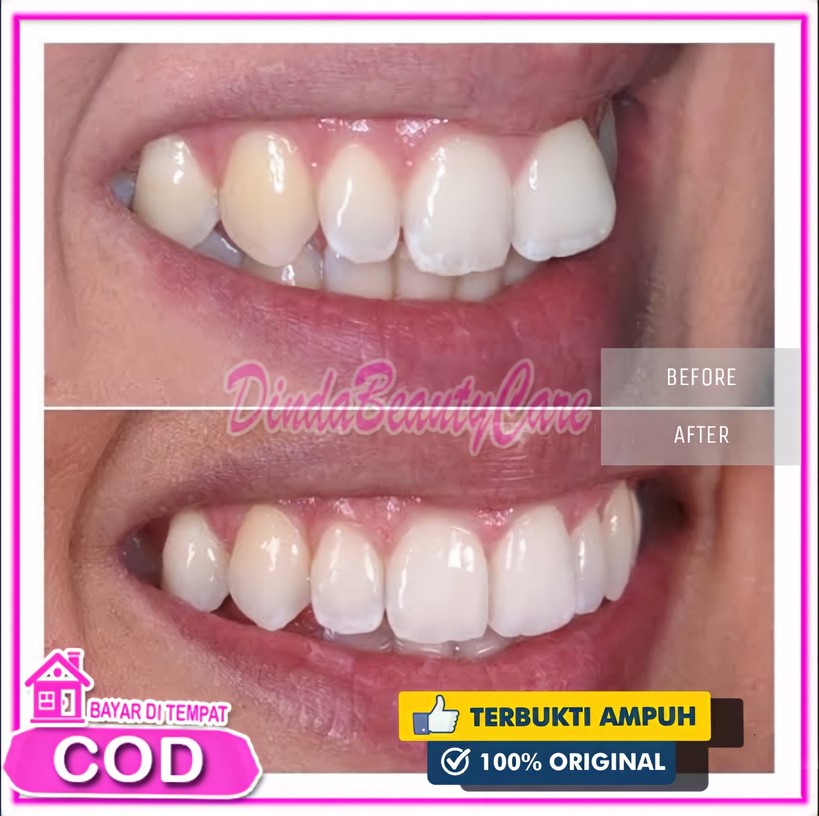 Alat untuk merapihkan gigi maju Alat perapih gigi tonggos original asli