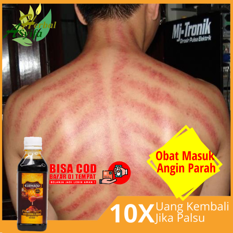 Obat Masuk Angin Parah Obat Sering Masuk Angin Obat Masuk Angin Tanpa Di Kerok Obat Herbal Masuk Angin Perut Kembug Meriang Mual Muntah Pusing Obat Masuk Angin Anak Dan Dewasa Tidak