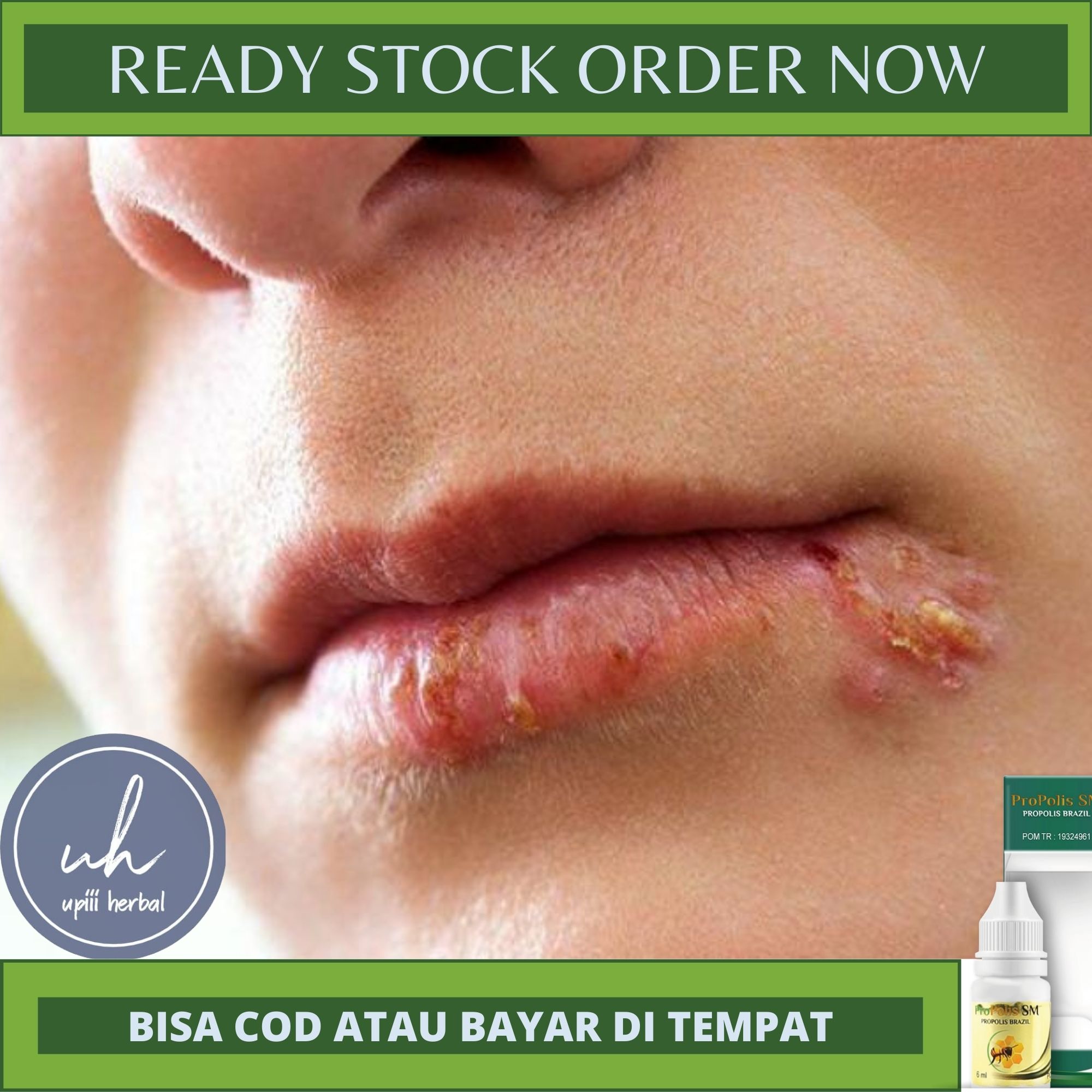 OBAT HERPES LABIALIS, OBAT UNTUK HERPES LABIASIS, OBAT ANTI VIRUS, OBAT