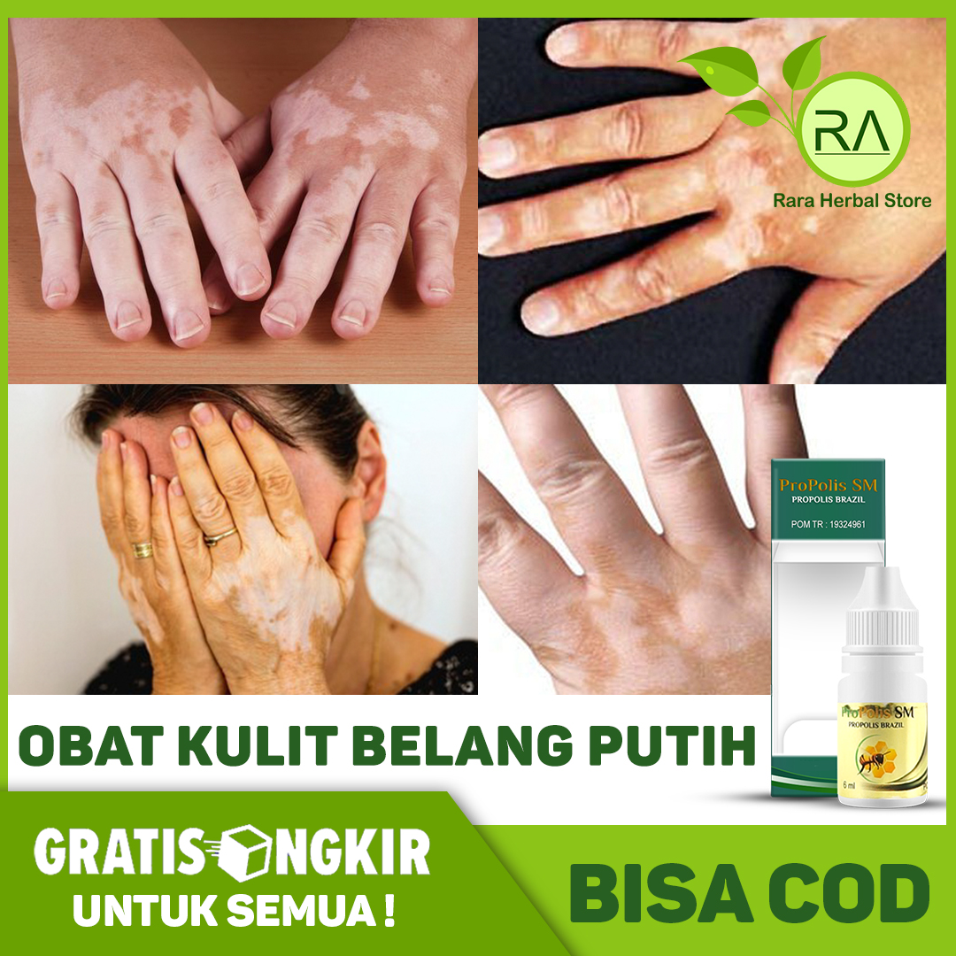 Jual Obat Kulit Belang Putih Tangan Terbaru Lazada Co Id