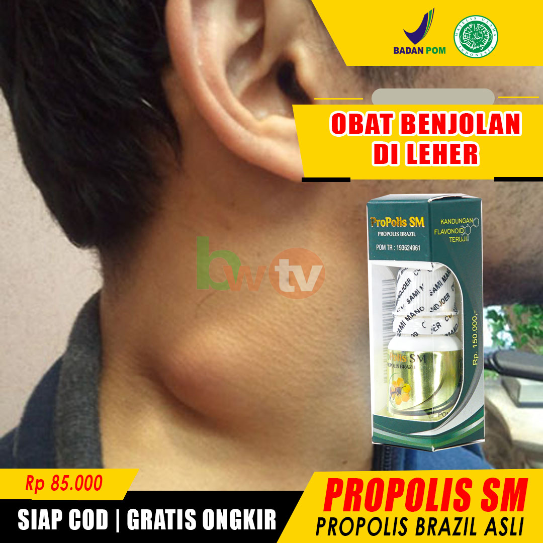 Obat Benjolan Di Leher Benjolan Belakang Telinga Pembengkakan Kelenjar Benjolan Sebelah Kanan Benjolan Di Bawah Dagu Kelenjar Tiroid Pembesaran Kelenjar Tiroid Kelenjar Getah Bening Propolis Sm Lazada Indonesia