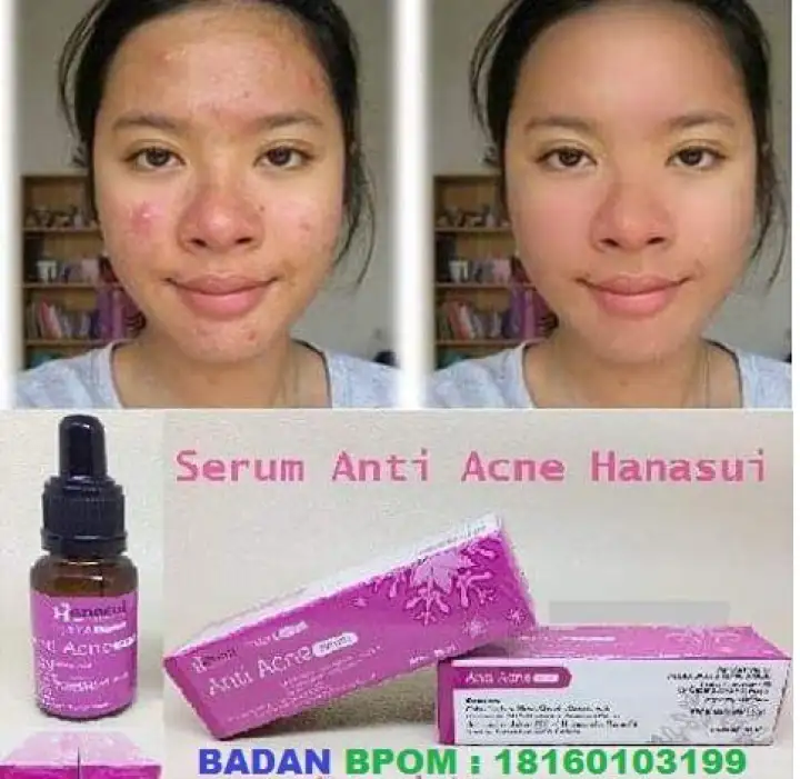 serum untuk acne