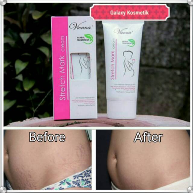 Vienna Stretch Mark Cream Bpom Krim Penghilang Stretch Mark Penghilang Stretchmark Krim Penghilang Stretchmark Selulit Dan Kerutan Pada Paha Atau Perut Setelah Melahirkan Lazada Indonesia
