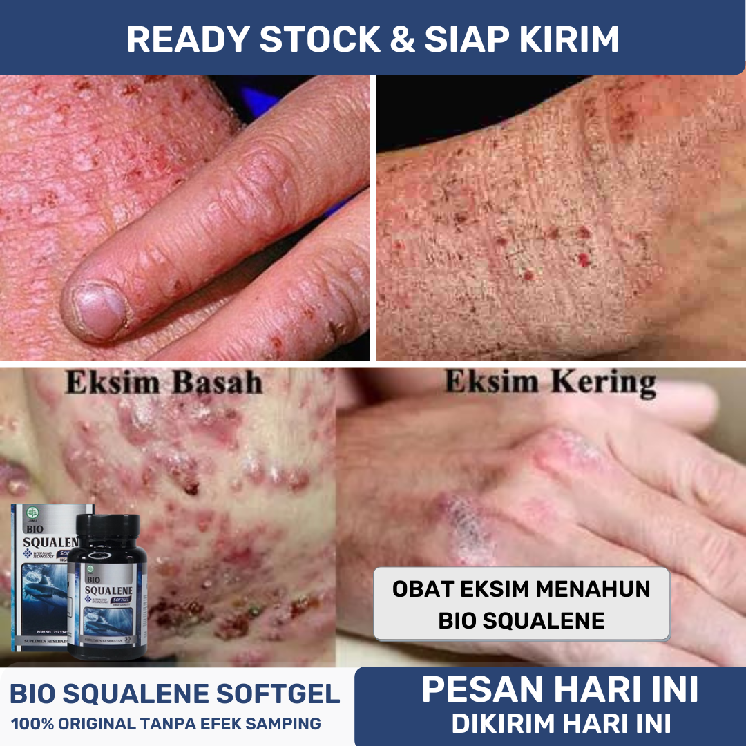 Obat Eksim Kering Menahun, Obat Eksim Basah, Obat Eksim Gatal, Obat ...