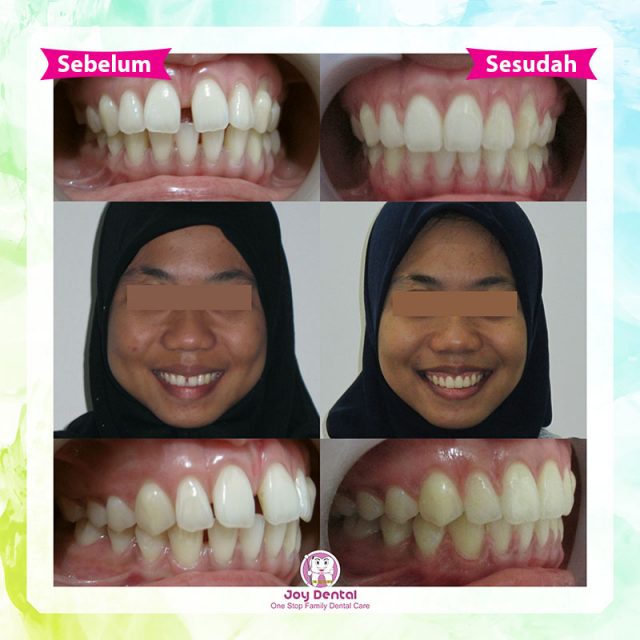 Alat Perapih Gigi Dijamin 100 Original Perapi Gigi Tanpa Behel Perata Gigi Karet Alat Merapikan Gigi Tanpa Behel Lazada Indonesia