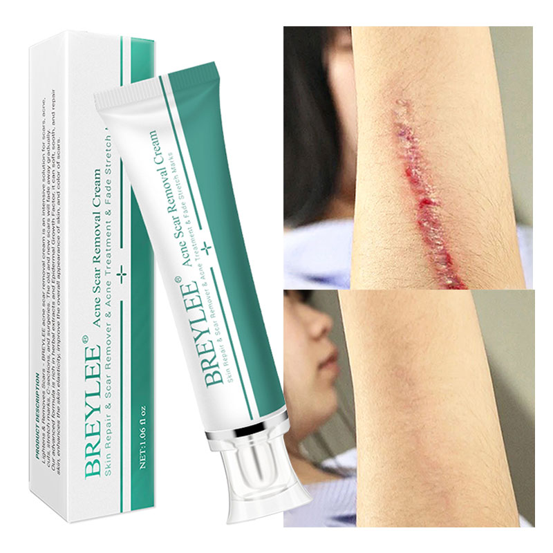 breylee scar removal cream