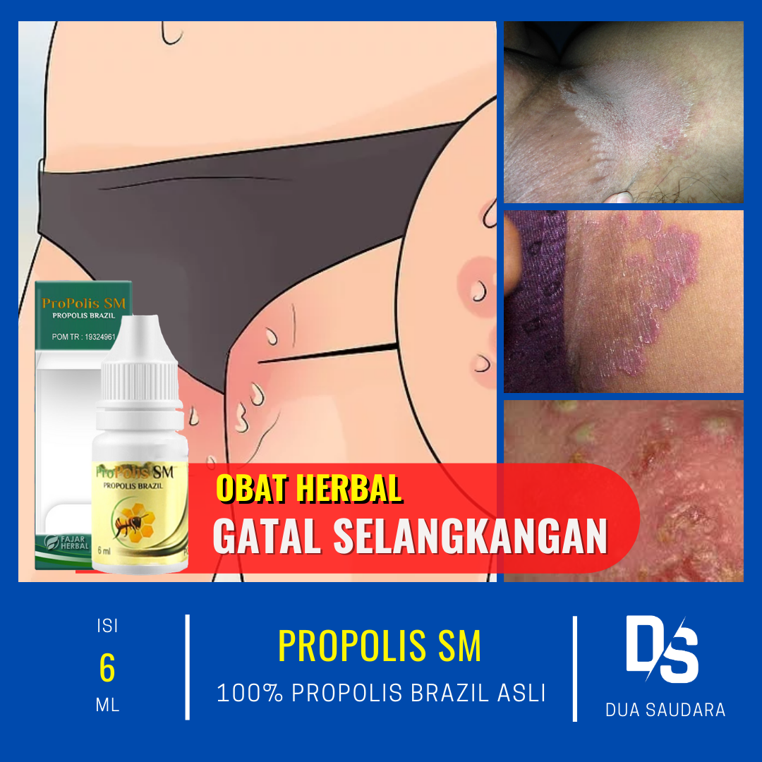 Obat Gatal Selangkangan Hitam Obat Tetes Gatal Gatal Gatal Selangkangan Obat Gatal Pada Kulit Dekat Kemaluan Propolis Sm Asli Lazada Indonesia