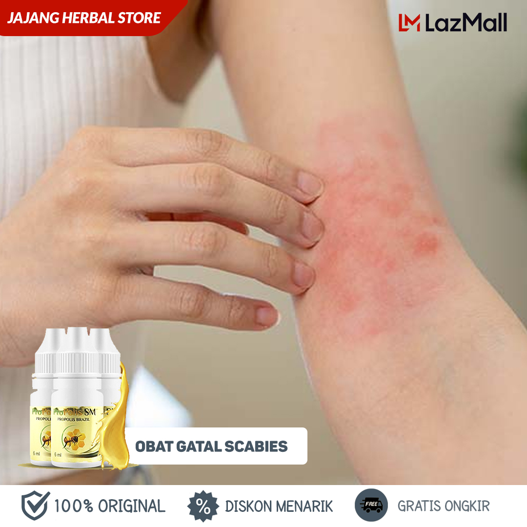 Obat Gatal Skabies Scabies Eksim Kurap Menahun Propolis Sm Brazil Lazada Indonesia