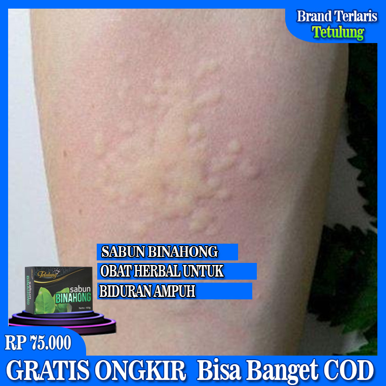 Sabun Binahong Obat Biduran Obat Biduran Alergi Obat Kaligata Obat Alergi Dingin Obat Kulit Gatal Obat Biduran Alergi Ampuh Obat Biduran Kronis Obat Biduran Menahun Obat Biduran Anak Obat Herbal Biduran Paling