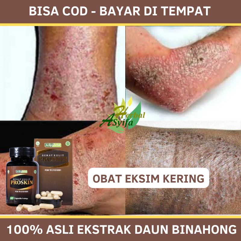 Kapsul Eksim Kering, Eksim Di Kaki & Tangan, Gatal Eksim Menahun, Kulit ...