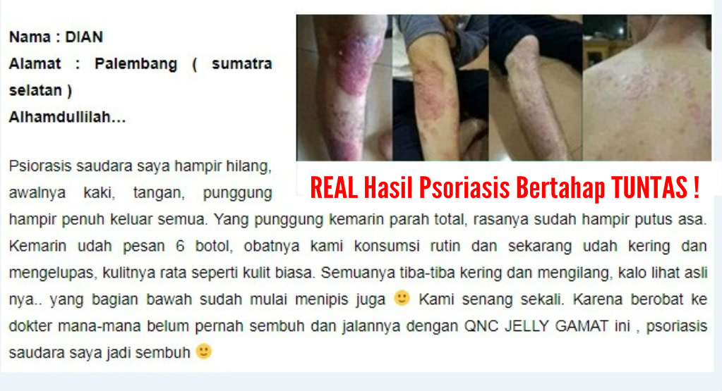 Qnc Jelly Gamat Obat Herbal Untuk Psoriasis Solusi Hilangkan Psoriasis Di Tangan Obat Alami Ruam Merah Kulit Kering Tebal Bersisik Dan Mudah Terkelupas Obat Trdaisional Gatal Dan Nyeri Pada