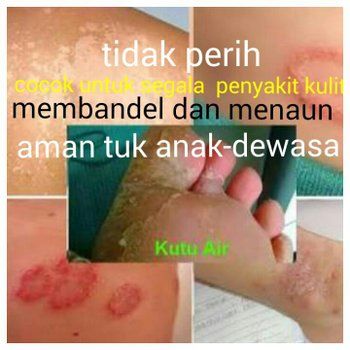 Original Obat Panu Kadas Kurap Cacar Air Gatal Paling Ampuh Salep Kl Hl Pi Kang Wang Asli Obat Gatal Pikangwang Obat Gatal Eksim Kulit Paling Ampuh Cina Salep Kulit Gatal Jamur