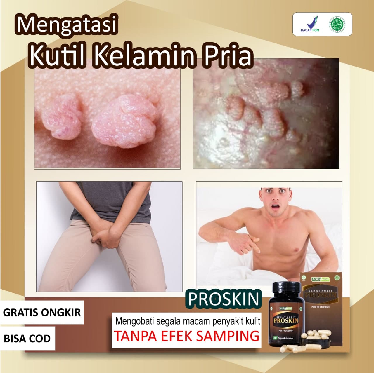 Obat Kutil Kelamin Pria Perontok Kutil Untuk Kutilan Papiloma Skin Tag  Daging Tumbuh Jengger Ayam Herpes Genital Selangkangan Gatal Berjamur  Infeksi Jamur Gatal Area Kemaluan Perih Herbal Proskin Sehat Kulit 100  Herbal