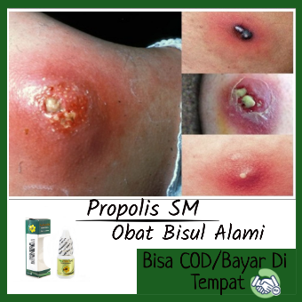 Obat Bisul Bisul Di Pantat Kemaluan Leher Telinga Bisul Di Kaki Bisul Di Punggung Obat Bisulan Obat Bisul Anak Obat Penghancur Bekas Bisul Obat Bisul Bernananh Obat Bisul Bengkak Obat Bisul Biar Gak Tumbuh Lagi Propolis Sm Lazada Indonesia