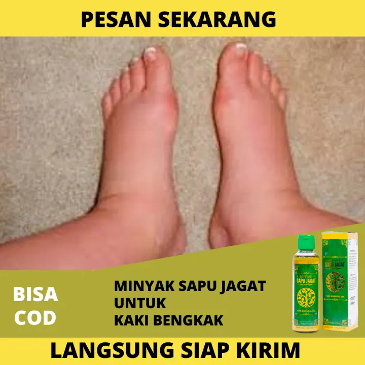 Tips Mudah Mengatasi Kaki Bengkak Secara Alami Honestdocs