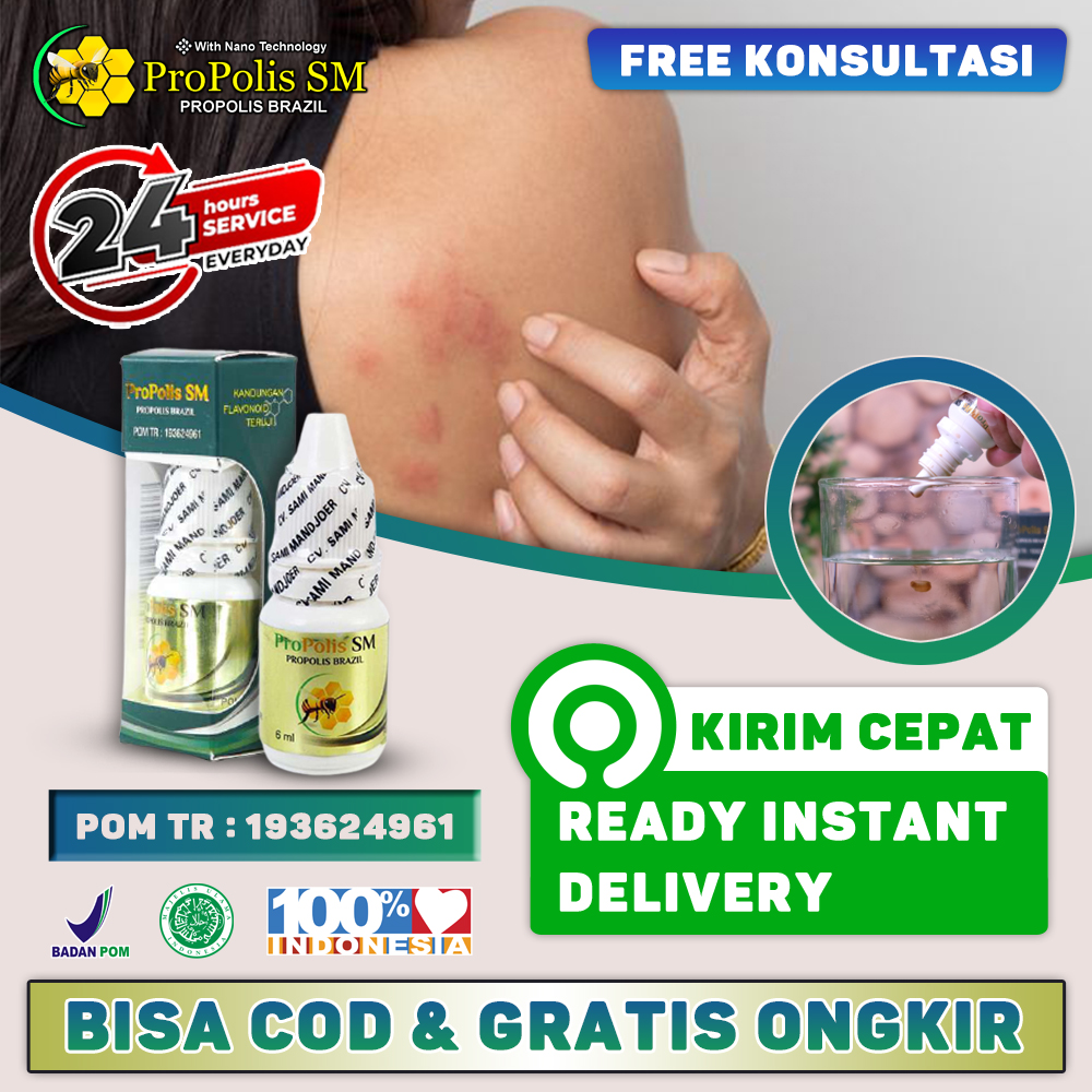 Obat Gatal Gatal Kadas Kurap Dengan Propolis Sm Obat Gatal Jamur Selangkangan Hapur Di Wajah