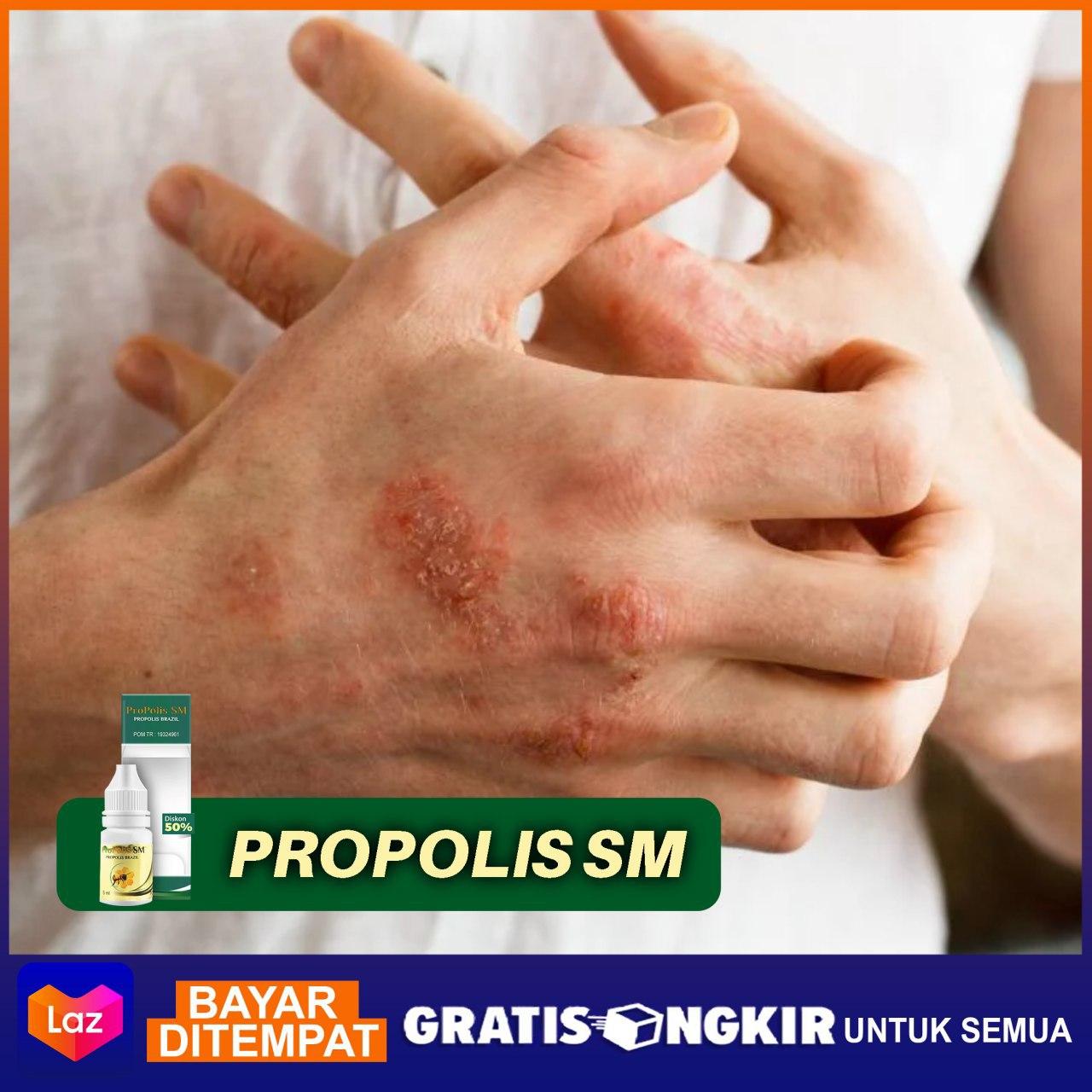 Herpes kulit luka kulit ruam lepuhan
