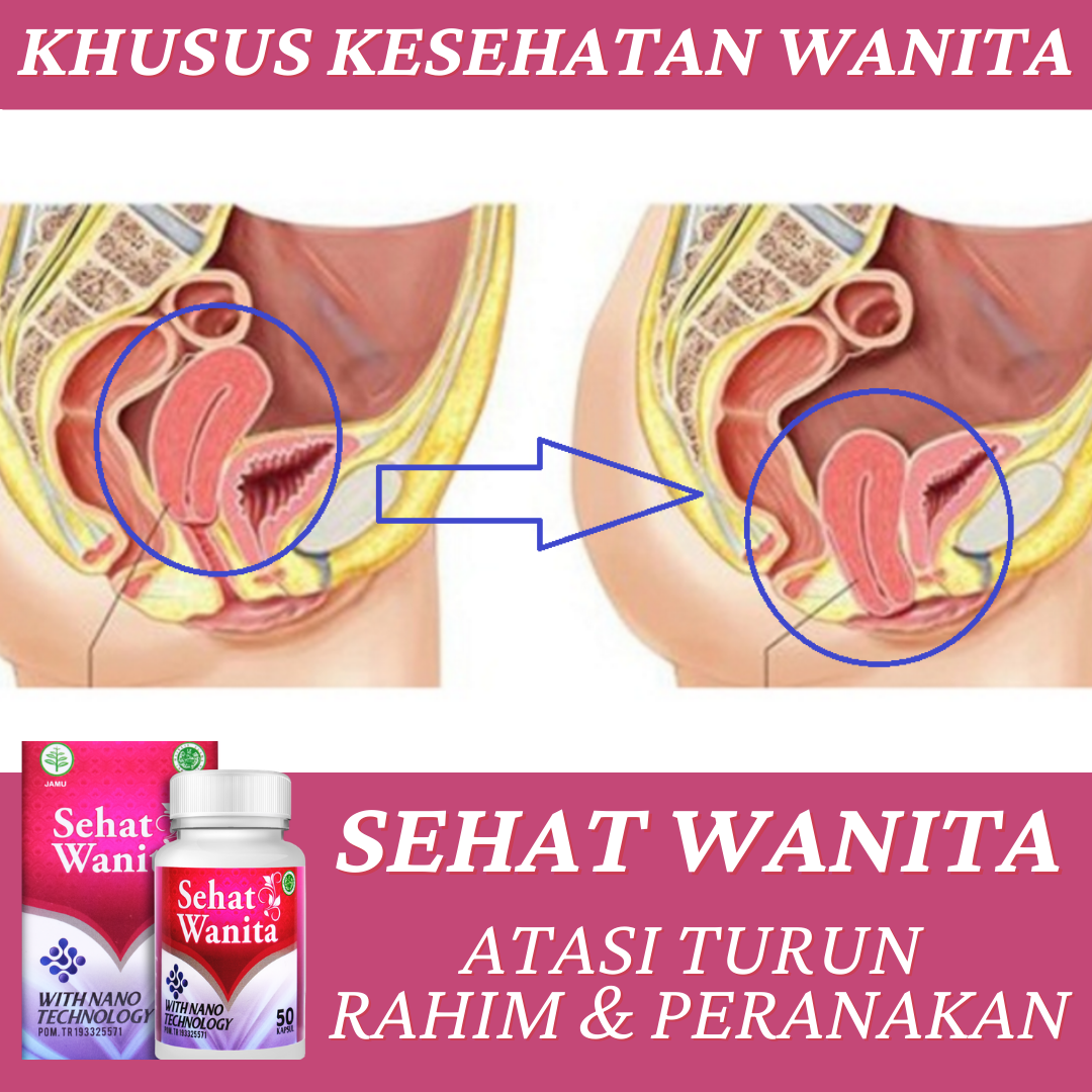 Obat Peranakan Turun Rahim Turun Rahim Peranakan Menonjol Ke Luar Vagina Prolaps Uteri Anterior Apikal Obat Turun Berok Sakit Panggul Mengatasi Kendur Peranakan Pasca Melahirkan Dengan Sehat Wanita