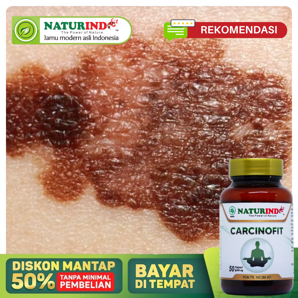 Obat Kanker Kulit Paling Ampuh, Obat Kanker kulit Melanoma, Obat ...