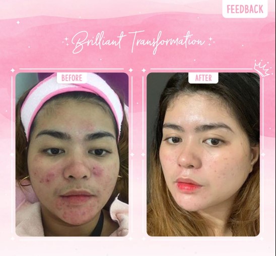 Brilliant Skin Rejuvenating Facial Set 4 Produk Original Skincare No 1 Philipina Ready Stock Lazada Indonesia