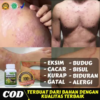 Obat Penyakit Eksim Gatal Alergi Basah Kering Bercak Merah Gatal Selangkangan Kadas Kurap Herpes Koreng Budug