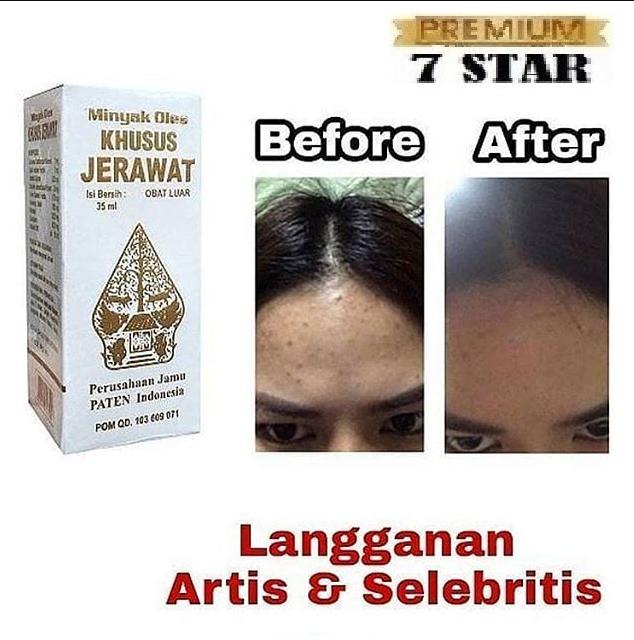 Obat Khusus Jerawat 35ml 7star - Obat Jerawat Cap Wayang - Penghilang Jerawat Obat Bisul Bpom - 1 Pcs By 7star Id