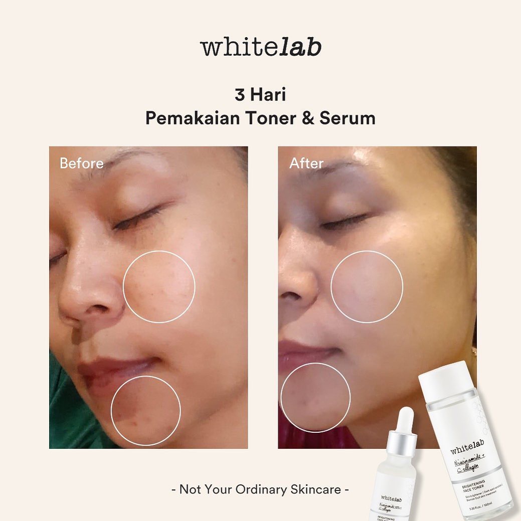 serum acne whitelab