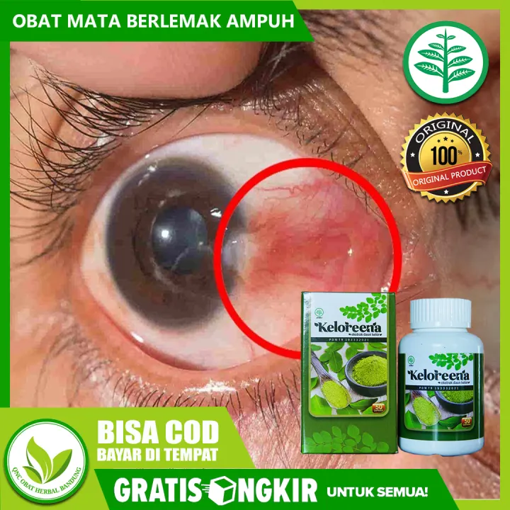 Obat Untuk Pterygium Mata Obat Mata Berlemak Obat Mata Berkabut Obat Herbal Jamu Keloreena Vitamin Kesehatan Mata Obat Pencerah Mata Keloreena 100 Ekstrak Daun Kelor Original Lazada Indonesia
