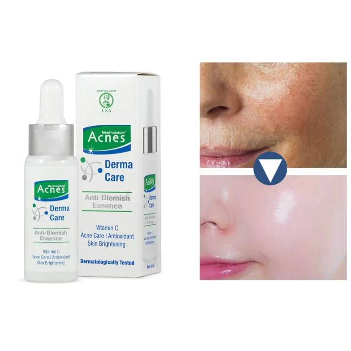 acnes derma care anti blemish essence