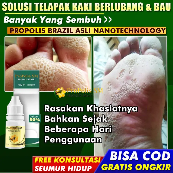 Obat Herbal Untuk Kapalan Obat Penghilang Ngilangin Kapalan Di Telapak Kaki Telapak Tangan Mata Kaki Tumit
